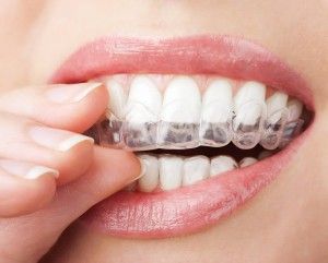 invisalign praxisklinik aachen 300x241